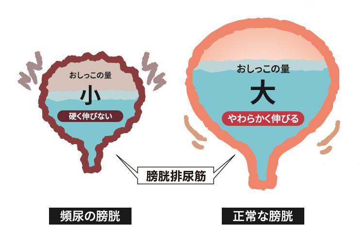 頻尿の症状とは